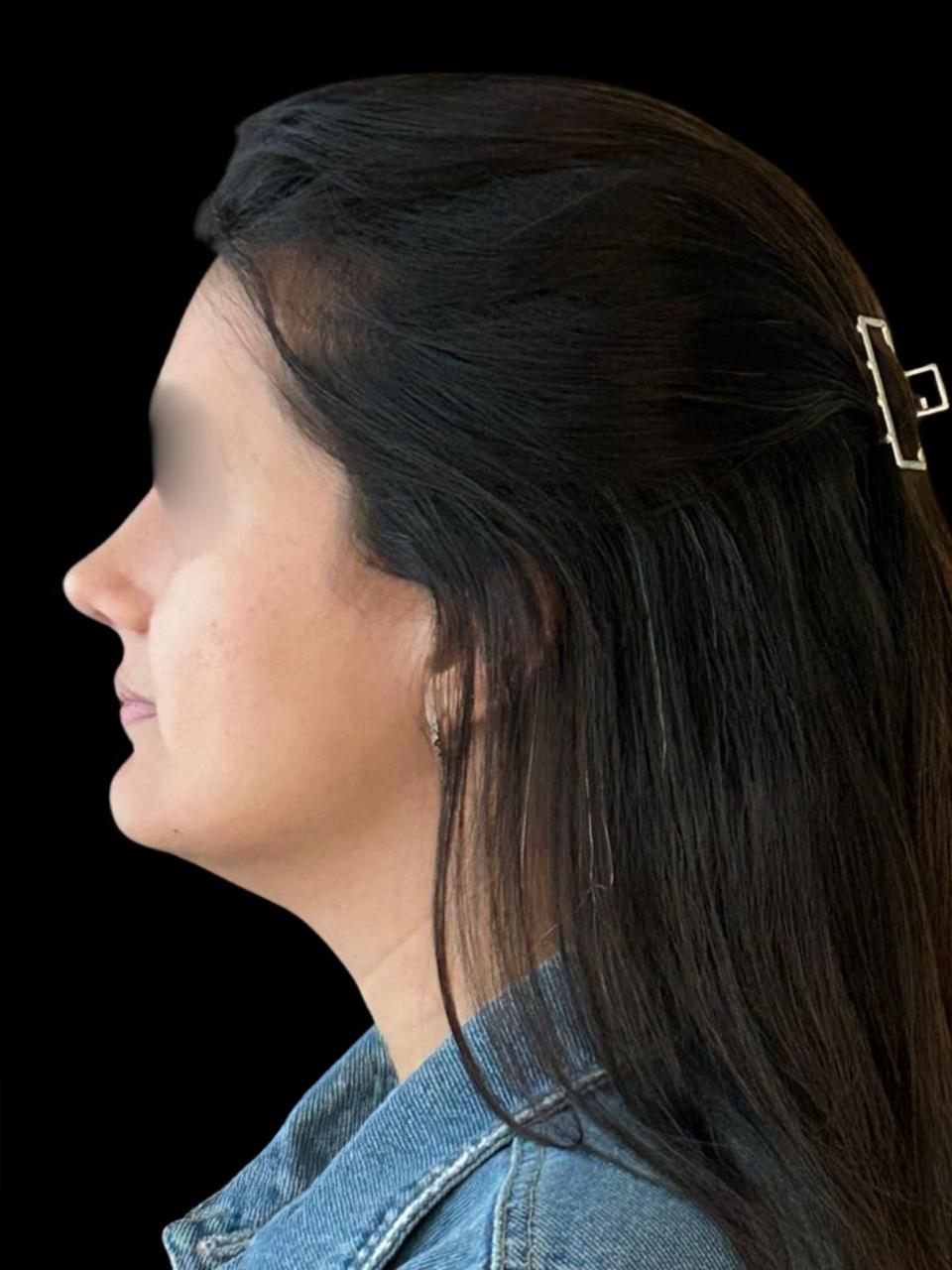 Depois - Paciente 002