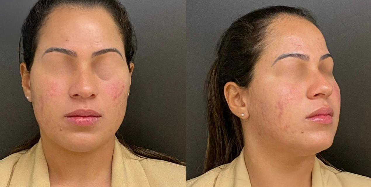 Antes - Paciente 003