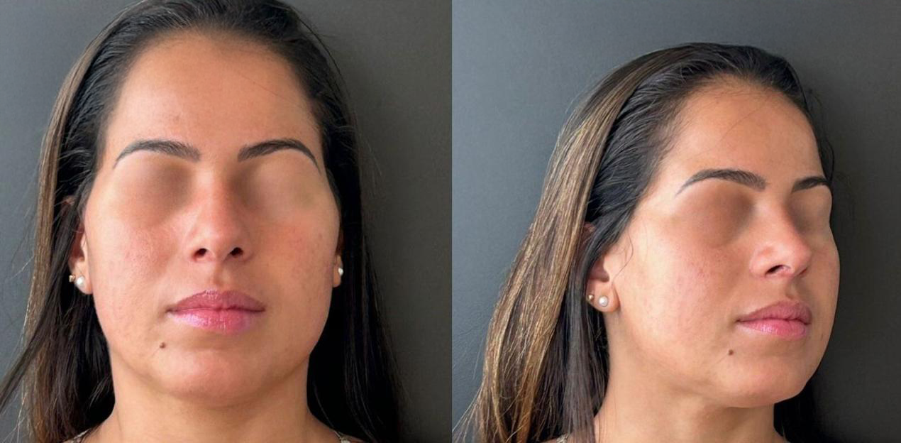 Depois - Paciente 003