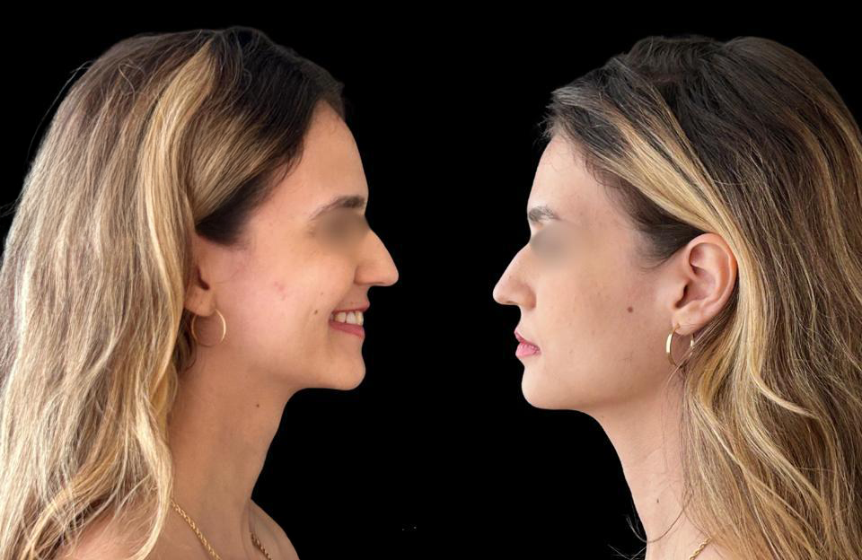 Antes - Paciente 004