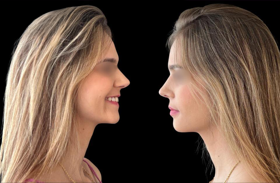 Depois - Paciente 004