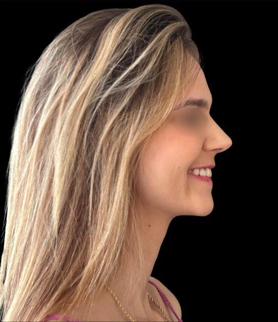 Depois - Paciente 005