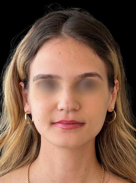 Antes - Paciente 006