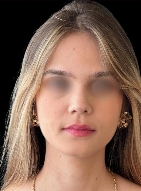 Depois - Paciente 006