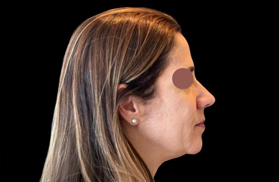 Antes - Paciente 007