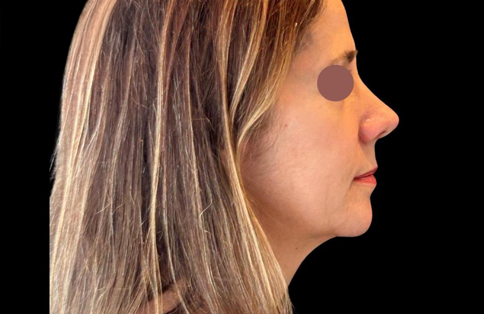 Depois - Paciente 007