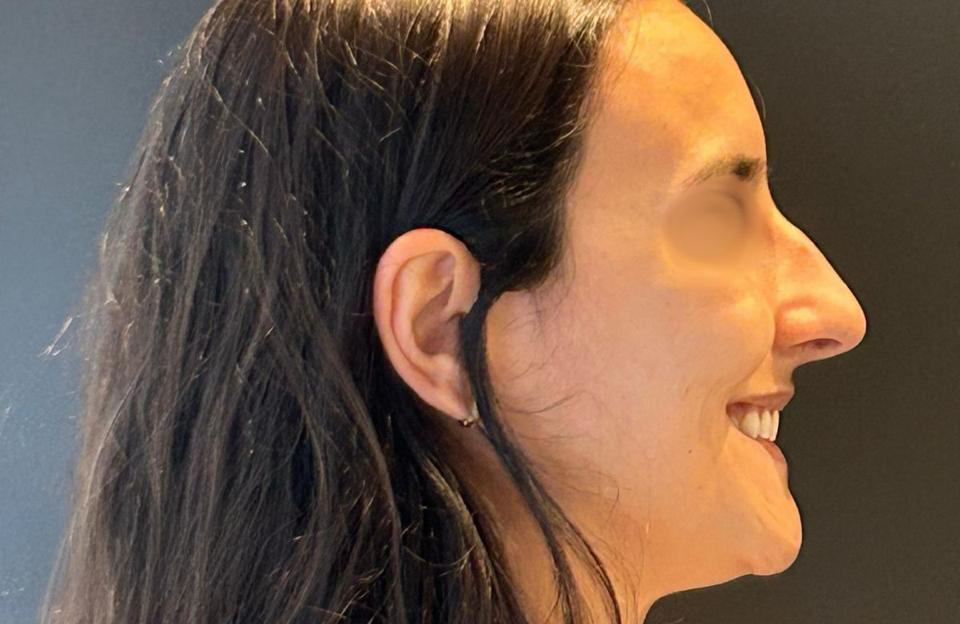 Antes - Paciente 008