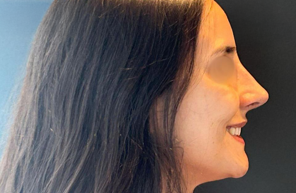 Depois - Paciente 008