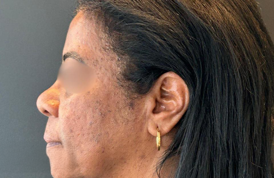 Antes - Paciente 009