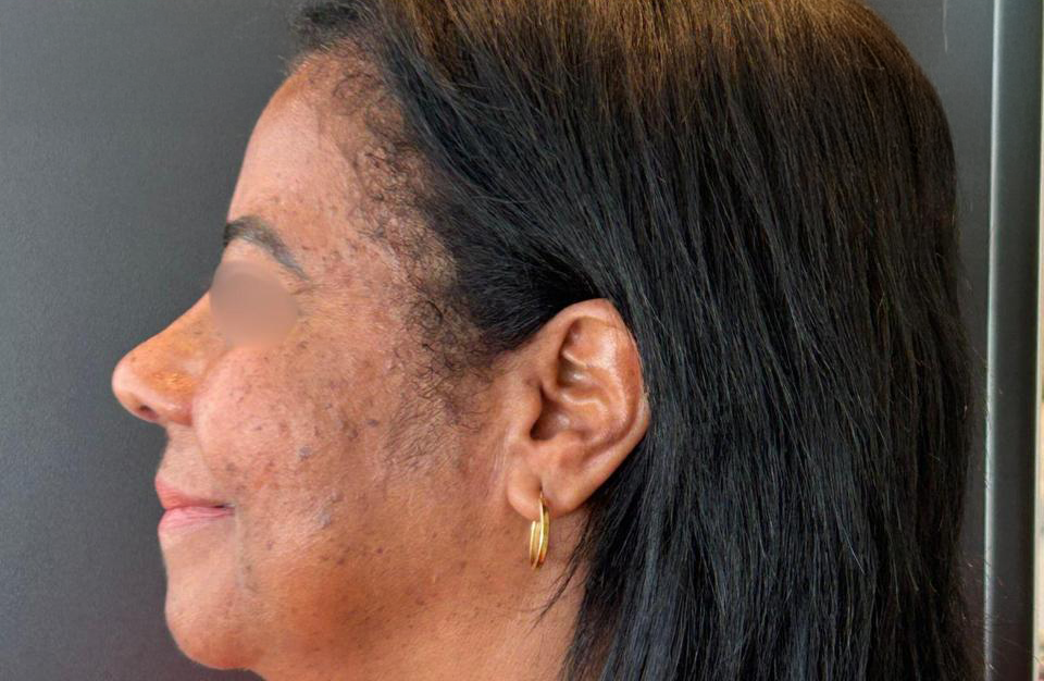 Depois - Paciente 009