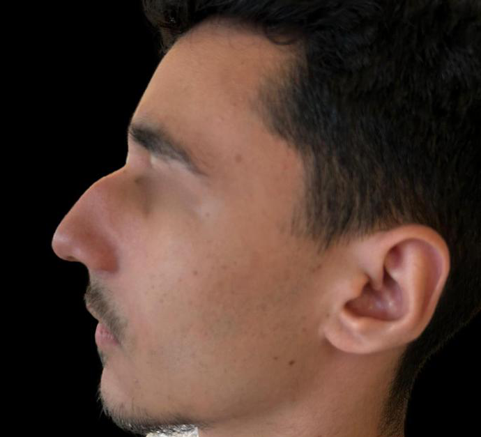 Antes - Paciente 010