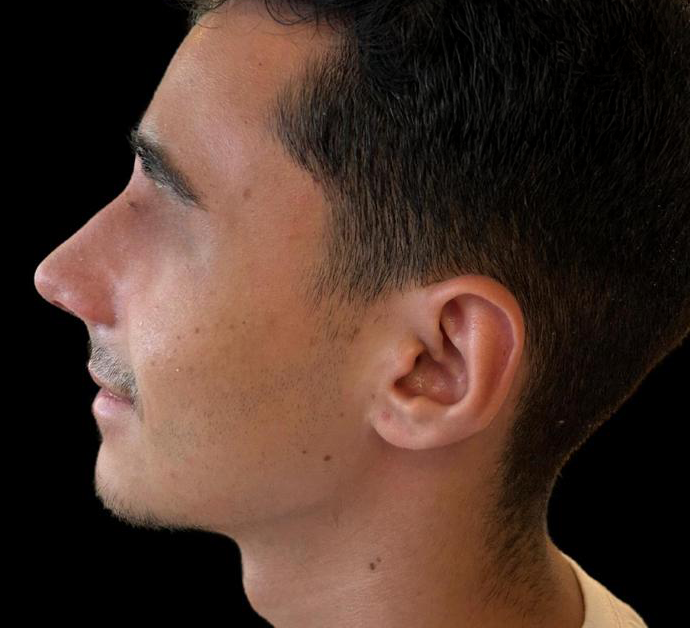 Depois - Paciente 010