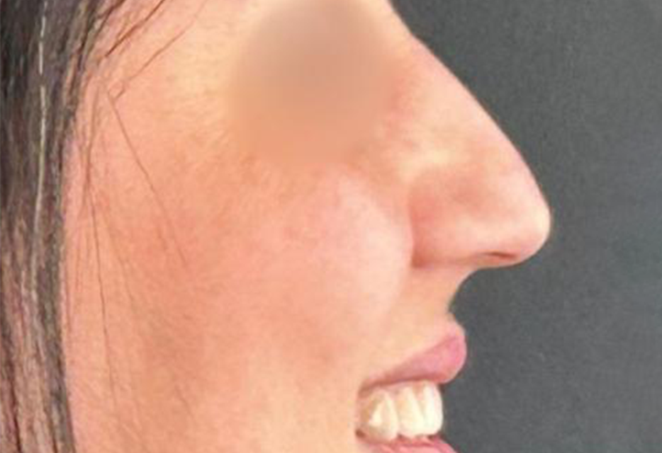 Antes - Paciente 011