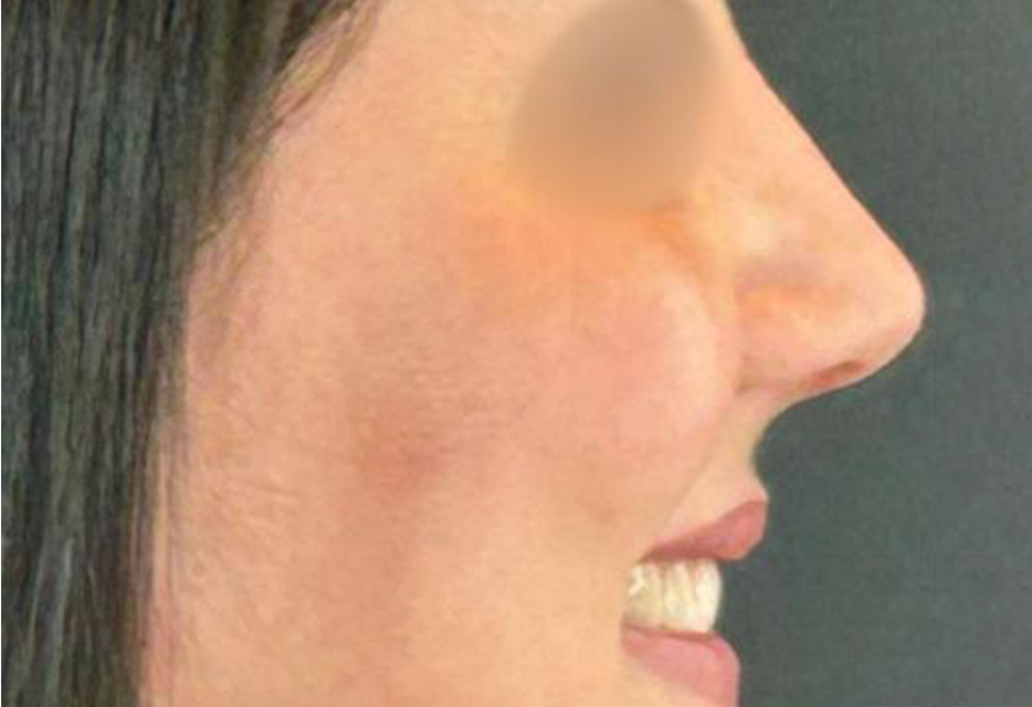 Depois - Paciente 011