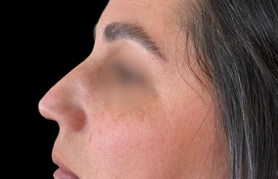 Antes - Paciente 012