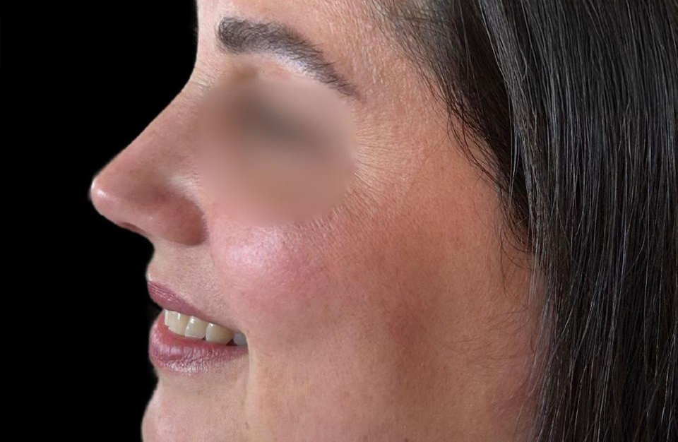 Depois - Paciente 012