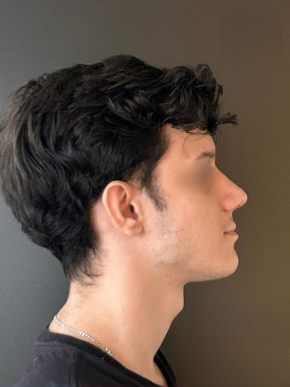 Depois - Paciente 013