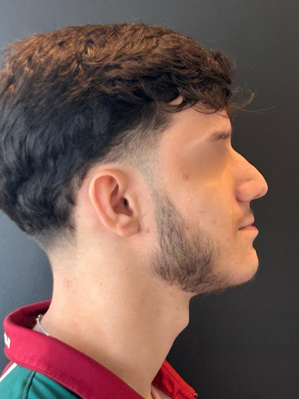 Antes - Paciente 013