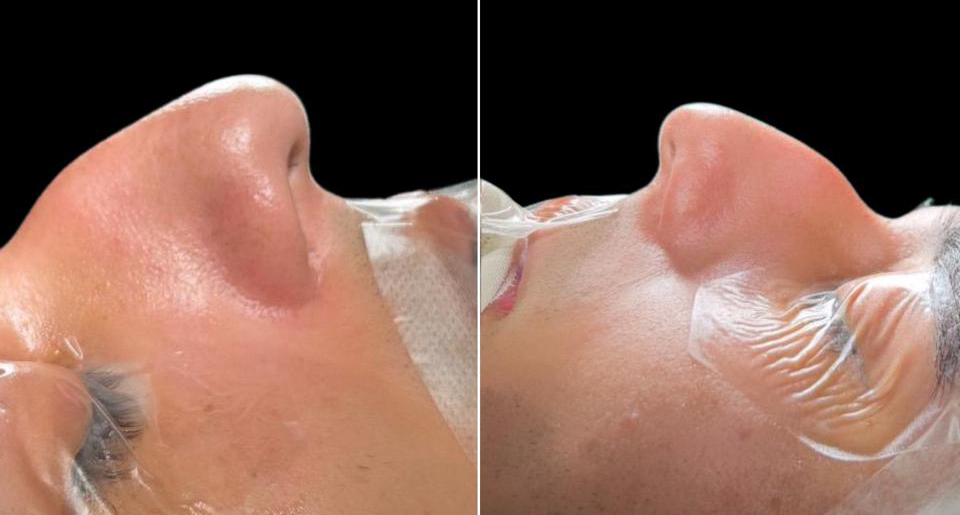 Antes - Paciente 014