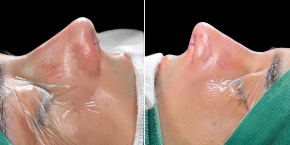 Depois - Paciente 014