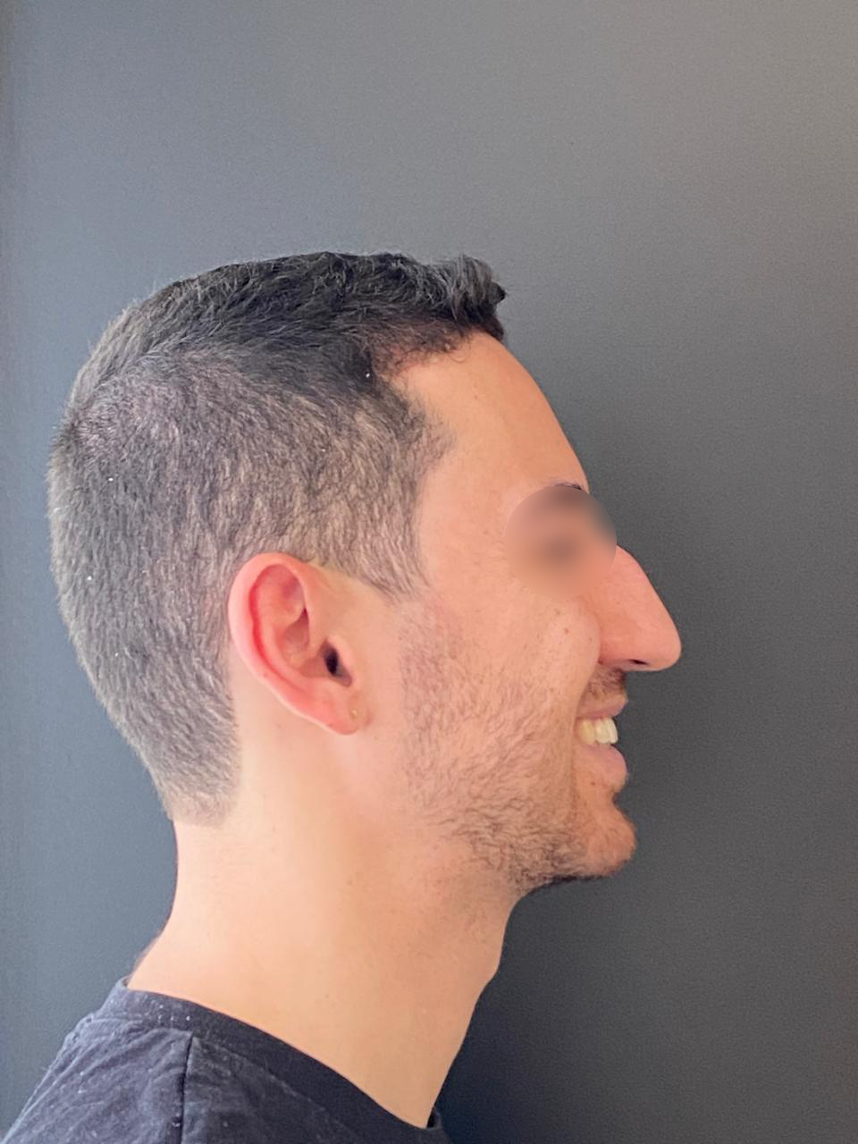 Antes - Paciente 015