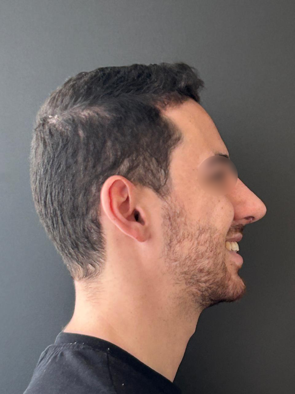 Depois - Paciente 015