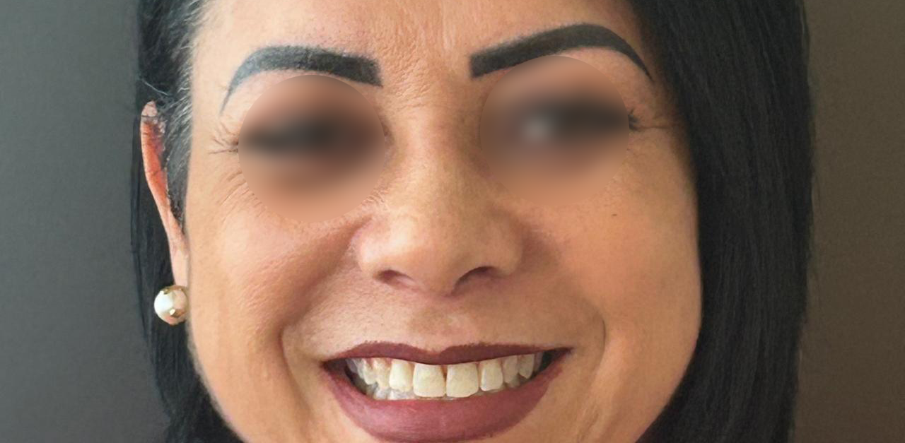 Depois - Paciente 016