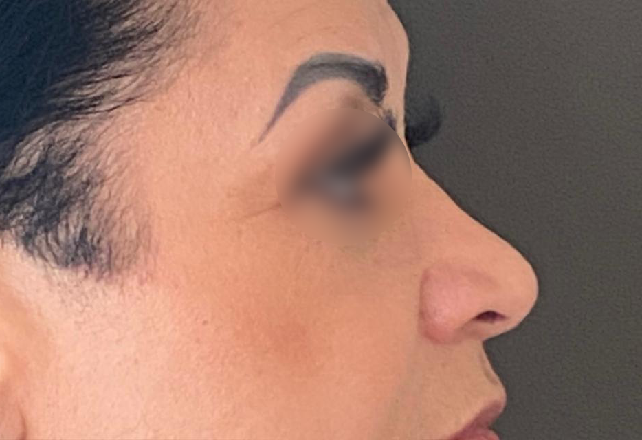 Antes - Paciente 017