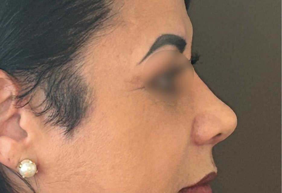 Depois - Paciente 017