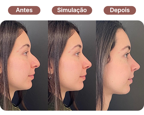 Simulação computadorizada de rinoplastia